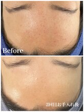 ピュア 川越店/光フェイシャル