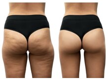 キラディ(KILADY)/デコボコ脂肪をつるつるに！