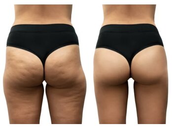 キラディ(KILADY)/デコボコ脂肪をつるつるに！