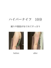グランツ 小山店/ハイパーナイフ施術