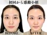 副院長KADOMORI式小顔矯正￥88550→￥70840