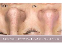 リバース 大阪店(Rebirth)/毛穴洗浄