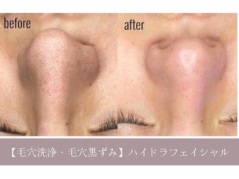 リバース 大阪店(Rebirth)/毛穴洗浄