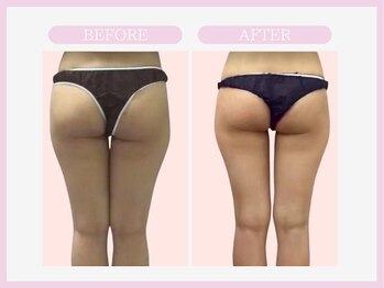 スリムライン 盛岡店(The Slim Line)/before→after