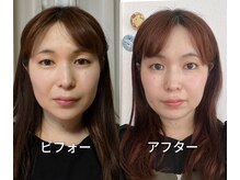 目元パッチリ！むくみが取れてお顔のパーツがハッキリしました♪