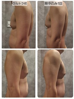 ヴィトワ(Vitowa)/ウルトランスフォーマー施術例7