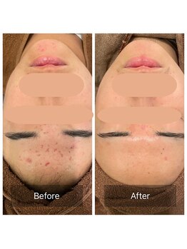 ビビ(VIVI)/繰り返すニキビに☆