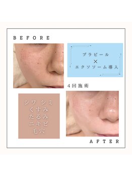 サロンシー(salon C)の写真/【毛穴のお悩み！肌質改善にも◎】韓国で人気の肌管理メニュー！プラピール・ララピール☆