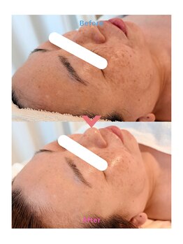 エテル(eter)/40代女性 水光ピール1回目