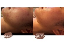 サロン リノ(salon rino)の雰囲気（3回目でほぼニキビ改善の秘密は完全オーダーメイドだから！）