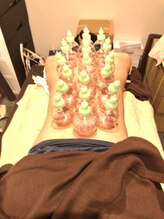 錦糸町はり灸院/だるさすっきり！カッピング