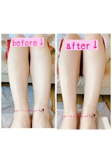 アモーレ プラス トゥエンティフォー(Amore +24)/フットトリートメントで浮腫改善