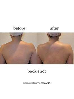 サロン ド ブラン アオヤマ(Salon de BLANC AOYAMA)/ビオフィート×ソノケア70分背中