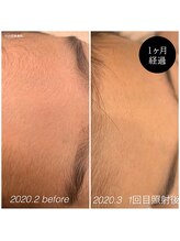 ティエラ(tierra)/キッズ顔脱毛