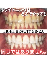 ライトビューティー 銀座店(LightBeauty)/東銀座 ホワイトニング症例写真