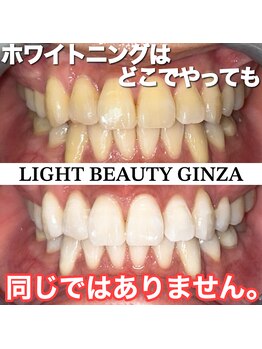 ライトビューティー 銀座店(LightBeauty)/東銀座 ホワイトニング症例写真
