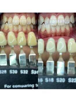 トウキョースワーズ 渋谷店(TOKYO SWRS)/#ホワイトニング #渋谷 #池袋