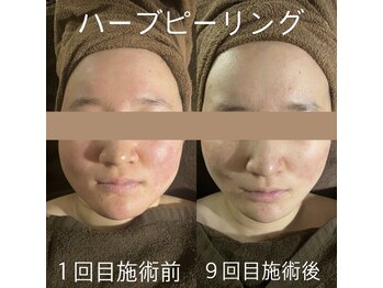 カヨン 新所沢店(KAYON)/肌質改善・小顔ケア・毛穴レスに