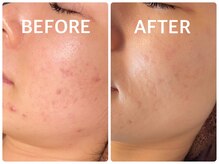 ハーブピーリング 心斎橋/ ハーブピーリングでニキビケア