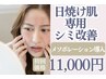 【日焼け】美容外科で断られる小麦色のお肌の方も大丈夫◎“夏シミ”速攻ケア