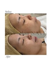 ナビ(NAVI)/シミくすみケア／美白肌管理