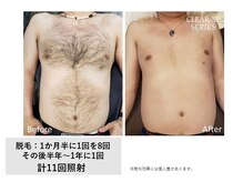 ザ エッセンシャル 碧南(THE Essential)/メンズ 胸＋お腹脱毛（Lパーツ）