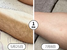 身だしなみラボ(MIDASHINAMILABO)/ふくらはぎ１回の効果