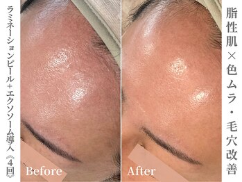 ゼアー(THERE FY.)/肌質改善化粧品の併用で効果UP