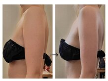 20代女性/ブライダル痩身６回/BeforeAfter写真