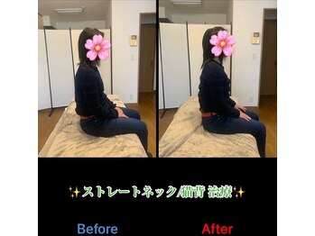 ヴィバランス(Vebalance)/ストレートネックと猫背の変化！