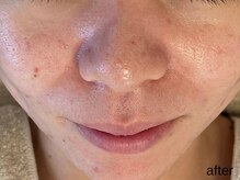 サロン ド エメ(salon de aimer)/【After】赤み改善、毛穴縮小