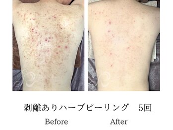 メンズミーシェ(Men's Meshie)/リベルハーブピーリング