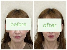 わかくさ鍼灸整体院/90%以上が小顔効果を実感♪