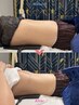 拘縮ケア　吸引のDTに/拘縮/たるみケア/むくみ/あざ/再生はやめる高周波