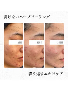 ラヴェンナサロン 札幌店(Ravenna salon)/REVIハーブピーリング♪