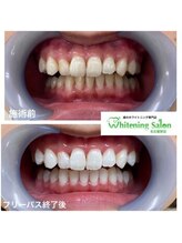 ホワイトニングサロン 名古屋駅店/【ホワイトニング施術例】