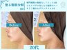 【二重あご解消】痛み0でアゴ下の脂肪を徹底ケア!初回体験60分[小顔]