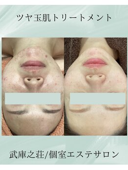 エデン(Eden)/艶肌トリートメント