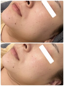 イル 名取店(iru)/プラズマフェイシャル