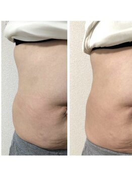 インナーエステ専門店　INNE【イネレ】/ビフォーアフター（前側）