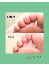 ふっとっと/角質ケア　before　after