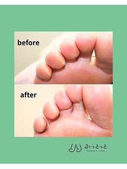 ふっとっと/角質ケア before after