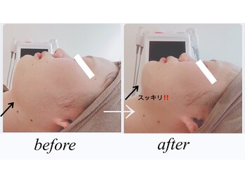 スリムアンドビューティー メゾン ド シュシュ(Slim&Beauty Maison de chouchou)/お顔スッキリ！！