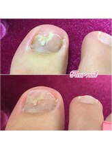 フルール(Fleur)/自爪補強ケア＊