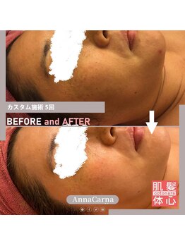 アンナカルナ(AnnaCarna)/くすみケアで印象が変わりますよ