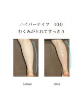 グランツ 小山店/ハイパーナイフ施術　ふくらはぎ