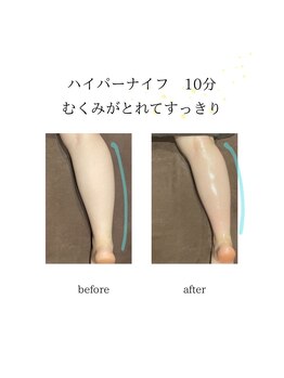 グランツ 小山店/ハイパーナイフ施術　ふくらはぎ