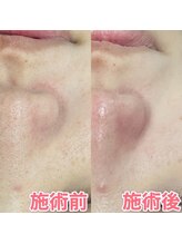 ピュアトゥルー 岐阜西店(PureTrue)/肌改善！