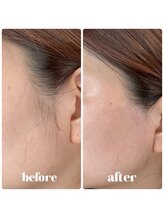 ビアス(VIAS)/フェイシャルワックス