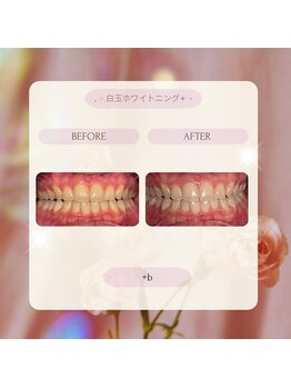 プラスビー 2号店(+b)/ホワイトニングビフォーアフター